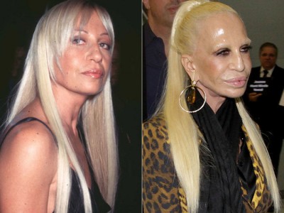 Before-After-Donatella-Versace-Plastic-Surgery.jpg