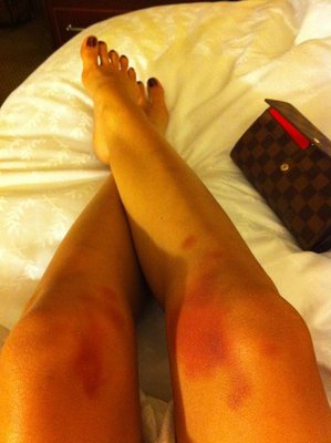 This is what I get for bumping and grinding like a slut on stage! Ouchhhhh.jpg