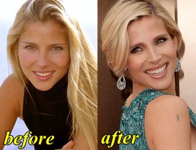 Elsa-Pataky-Plastic-Surgery-Before-and-After.jpg