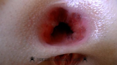 Evelina-darling's-anus-after-DAP.jpg